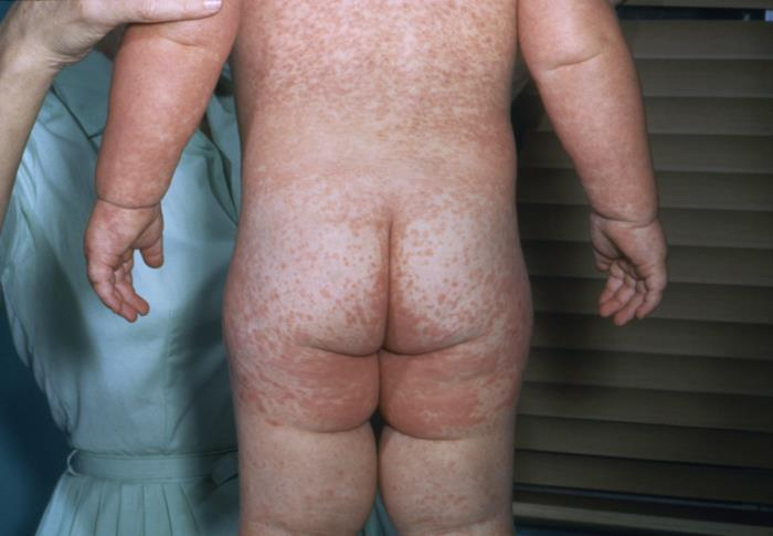 Sarampo - Manchas vermelhas no corpo
