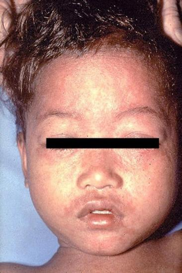 Sarampo - Detalhe facial