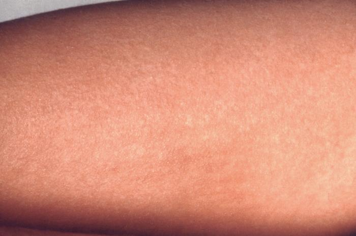 Escarlatina - Rash no dorso