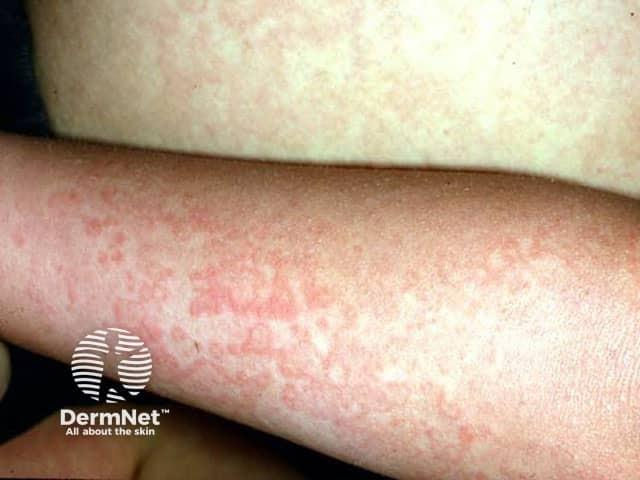 Eritema Infecioso - Rash rendilhado
